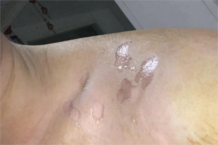 小儿海鲜过敏肩部渗液图 小儿海鲜过敏肩部渗液图