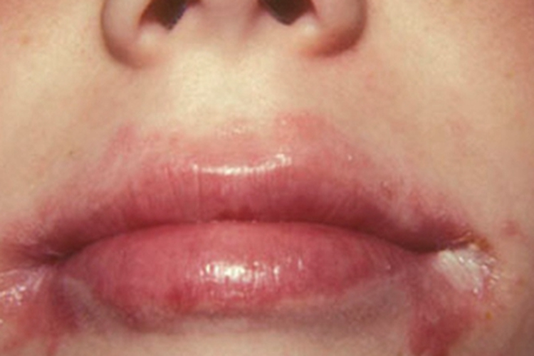 营养不良性口角炎嘴唇症状图