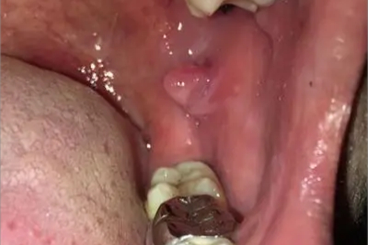 颗粒型口腔红斑口腔症状图