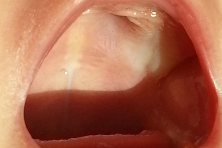 婴儿口腔白斑初期图