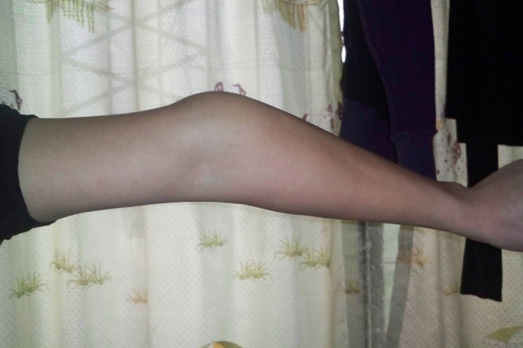 手肘外翻图 手肘外翻图