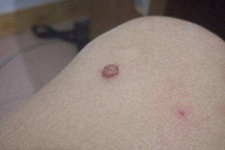 复合痣膝盖症状图