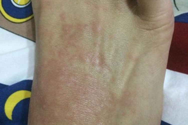 脓毒败血症疹脚背小疙瘩图