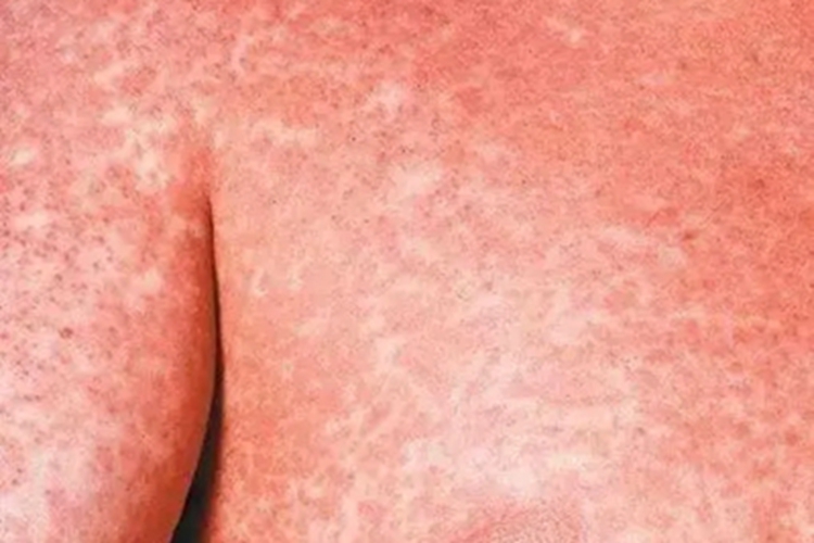 普通型猩红热胸部小红疙瘩图