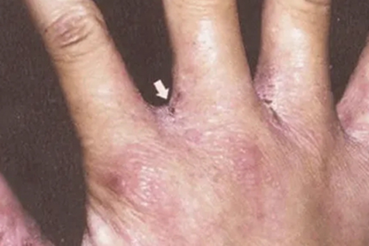 结痂性疥疮手指缝结痂皲裂图 结痂性疥疮手指缝结痂皲裂图