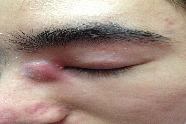 皮脂腺囊肿图 皮脂腺囊肿图