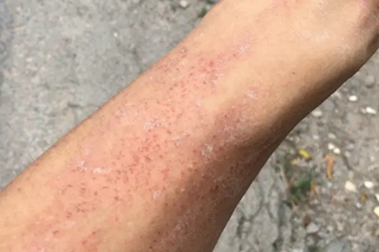 神经官能症性表皮剥脱脱屑图 神经官能症性表皮剥脱脱屑图