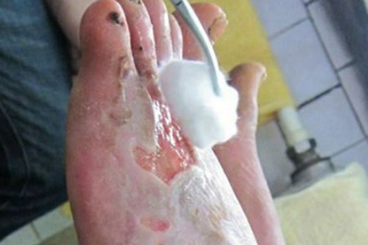 红斑性肢痛症脚部溃疡图