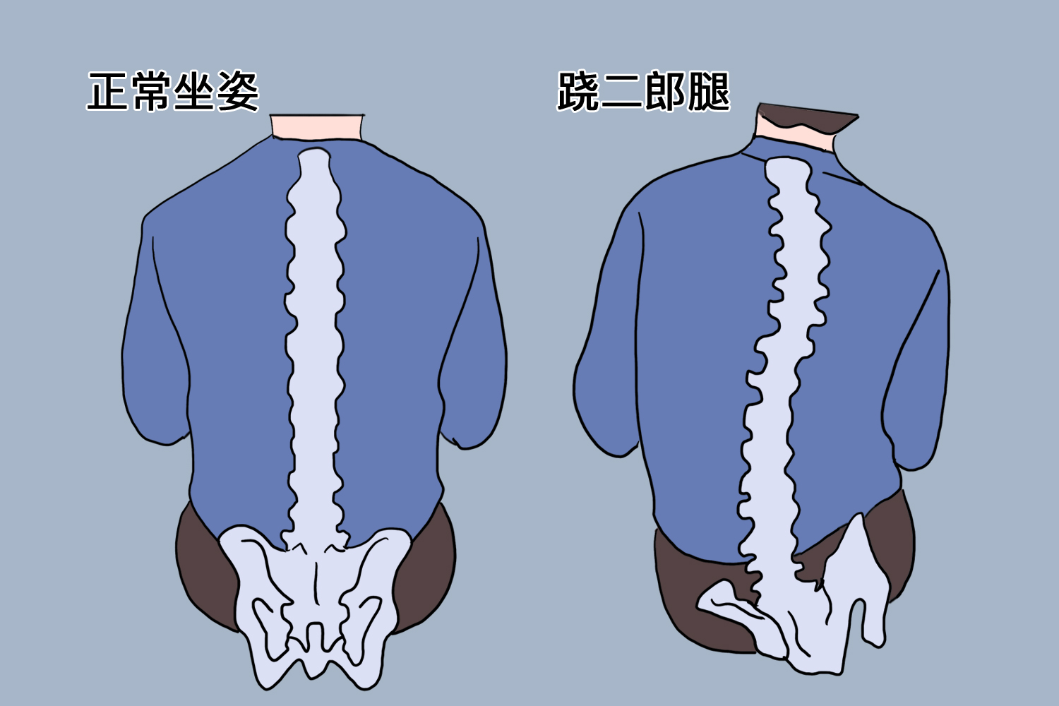 跷二郎腿脊椎变形与正常脊椎对比图 跷二郎腿脊椎变形与正常脊椎对比图