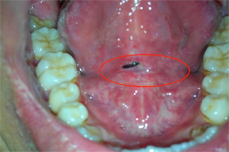 舌系带断裂严重图