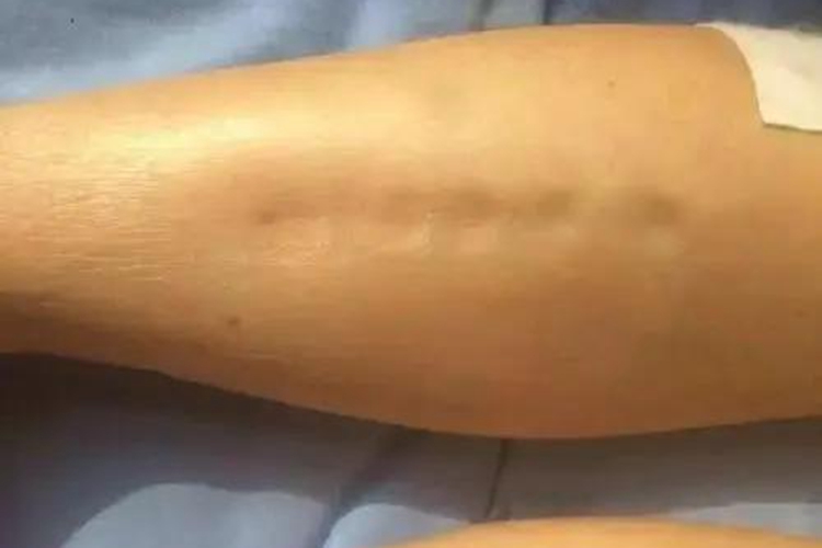 肾炎下肢腿部凹陷性水肿图 肾炎下肢腿部凹陷性水肿图