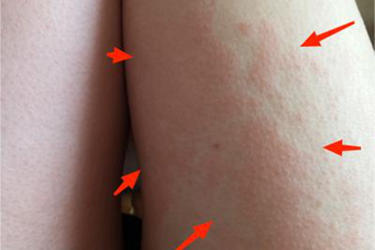 海鲜过敏大腿上长红斑图 海鲜过敏大腿上长红斑图