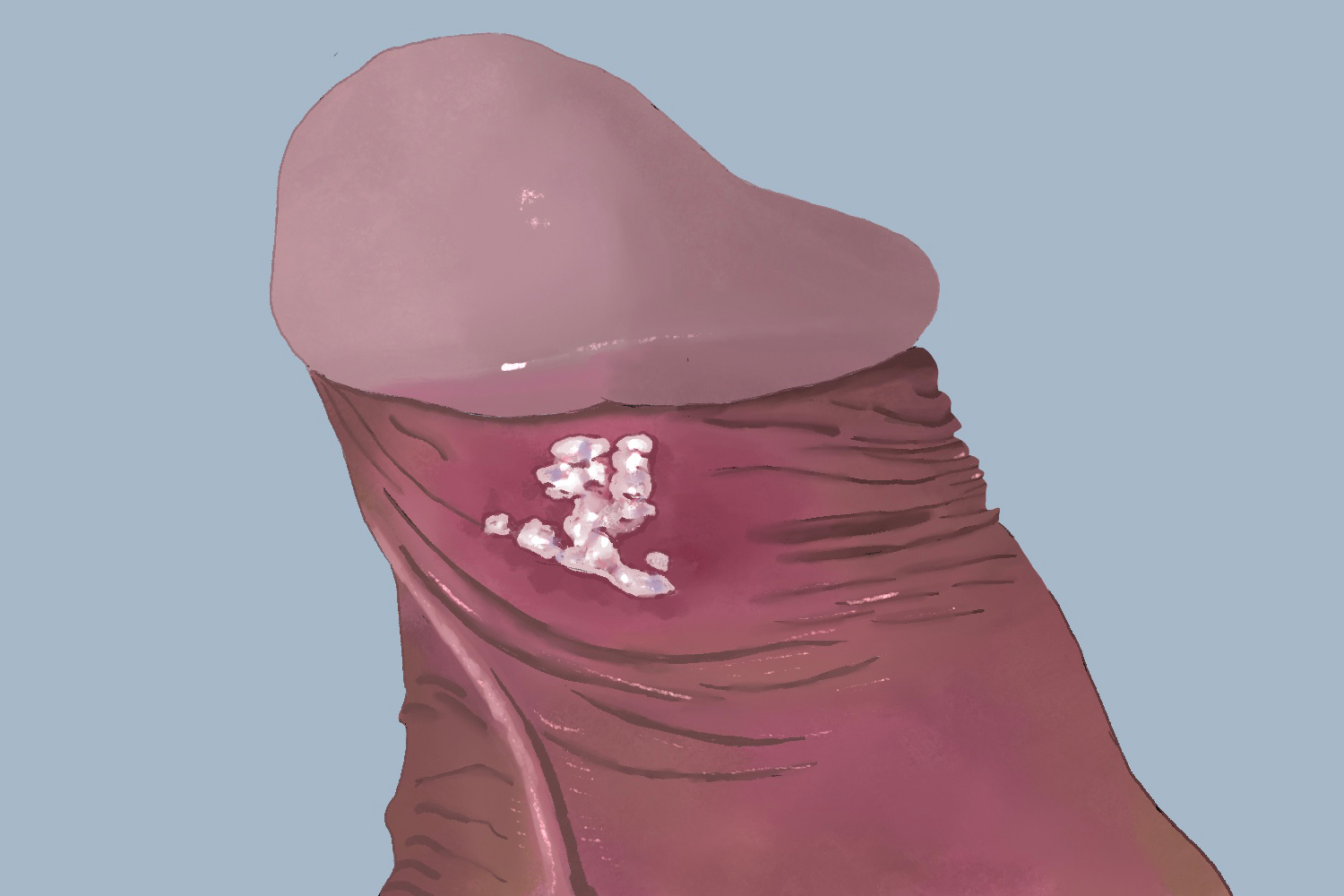 男性生殖器疱疹阴茎手绘图