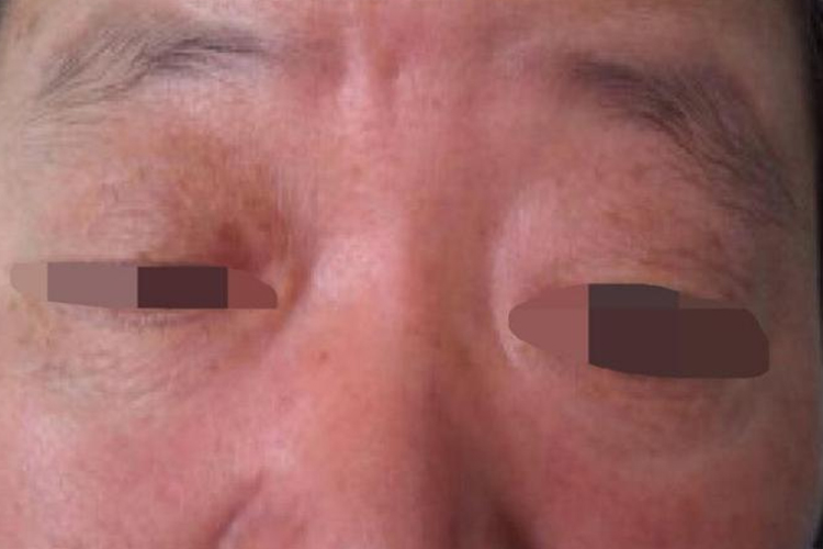 一氧化碳中毒面部樱桃红图 一氧化碳中毒面部樱桃红图