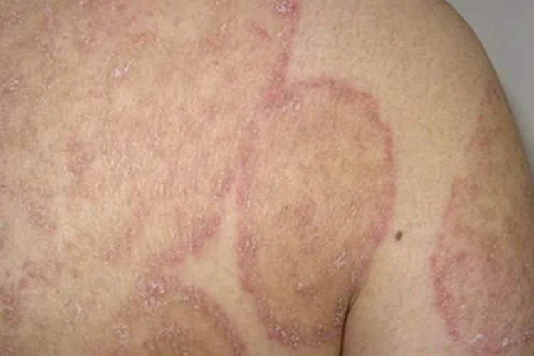 体癣肩部症状图 体癣肩部症状图