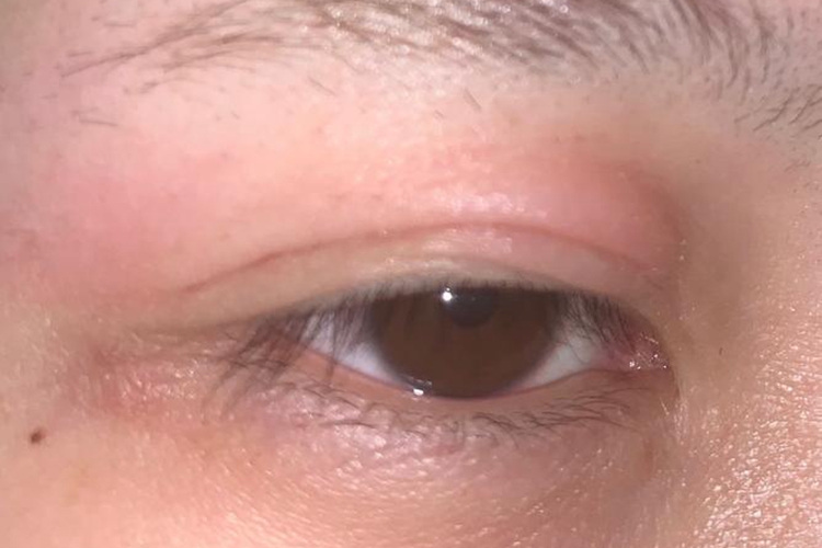 上眼皮虫咬肿胀图