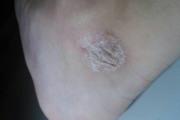 体癣致脚踝皮肤角质化图 体癣致脚踝皮肤角质化图