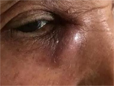 慢性泪囊炎眼周有红色肿胀的大包图