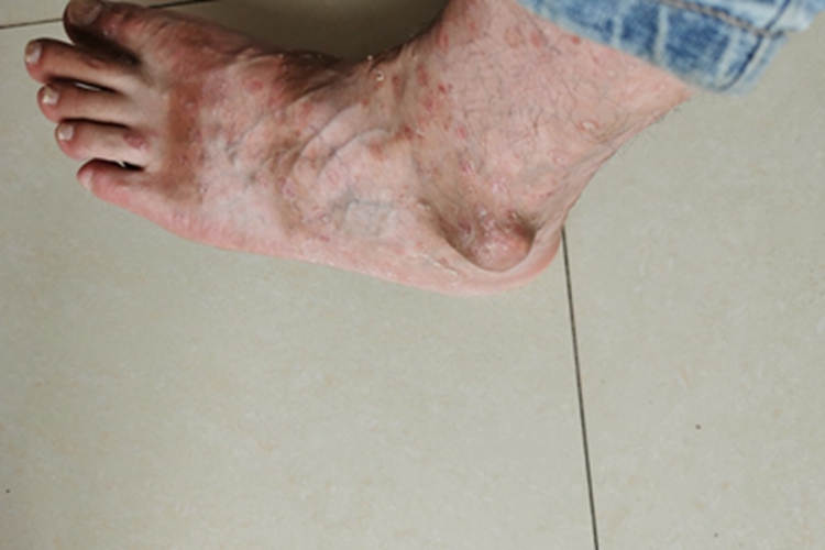 痛风脚踝症状图 痛风脚踝症状图