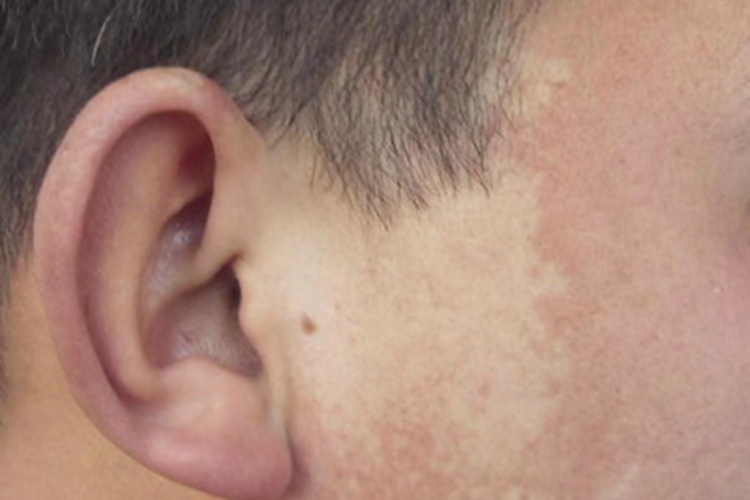 无色素痣耳周症状图
