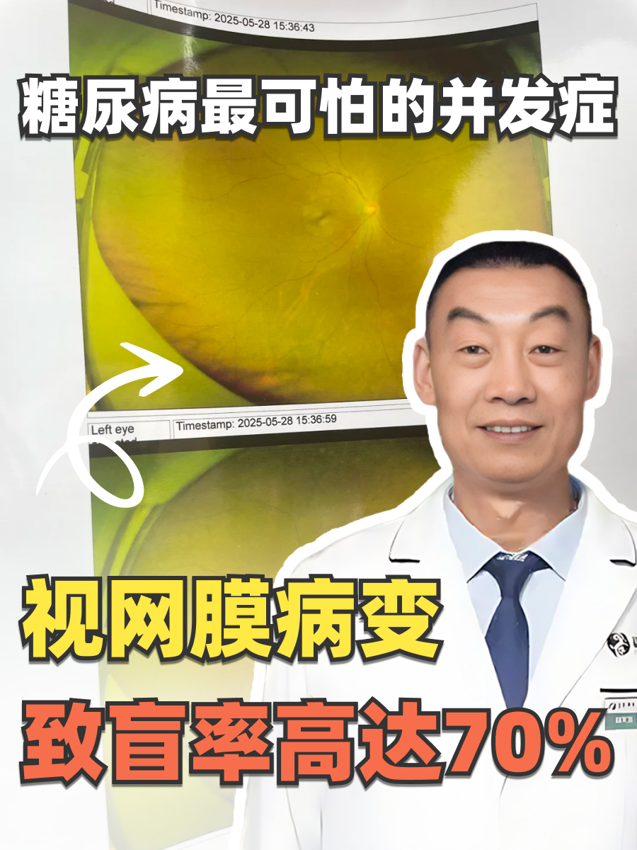 糖尿病最可怕的并发症——视网膜病变