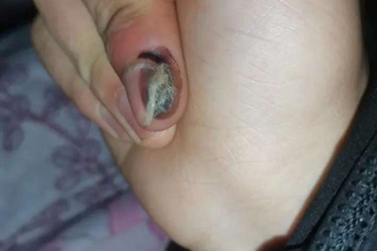 寻常疣甲床脱落皮肤发黑图