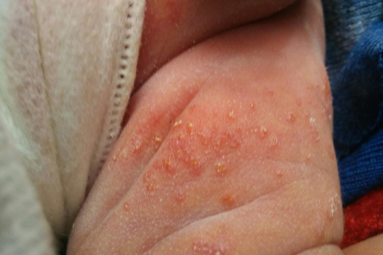 大腿内侧湿疹图