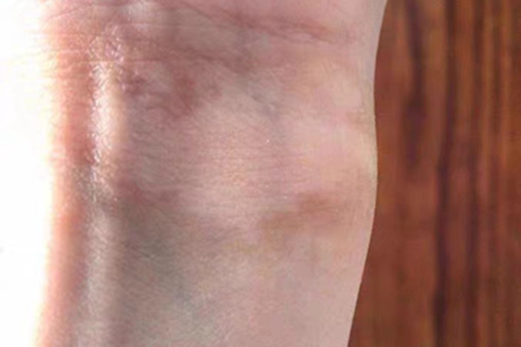 进展期节段型白癜风手腕斑图