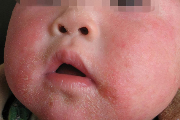 干燥型湿疹图 干燥型湿疹图