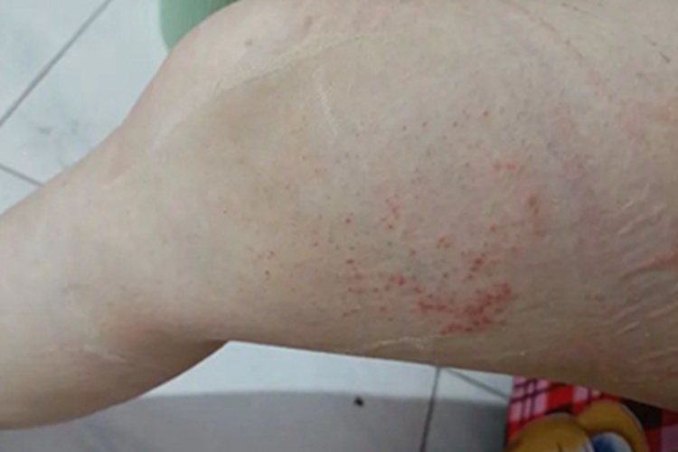 亚急性接触性皮炎大腿症状图