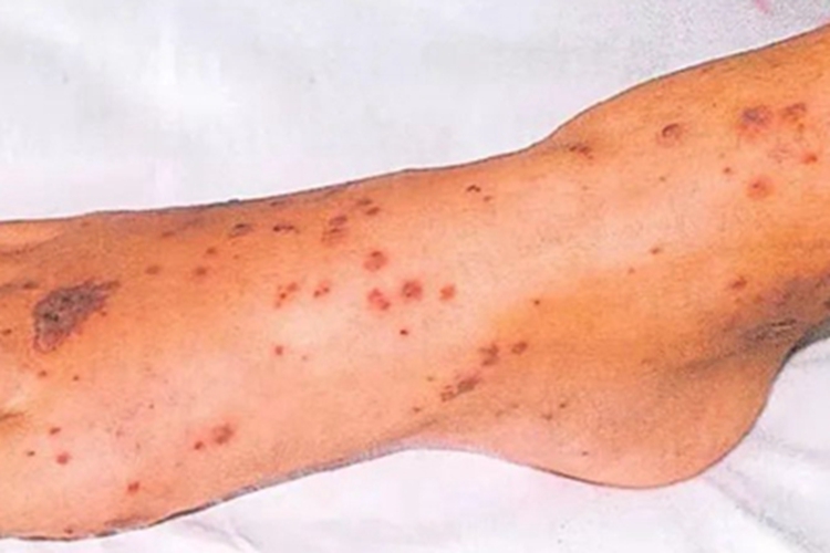 变应性皮肤血管炎脚背丘疹图 变应性皮肤血管炎脚背丘疹图