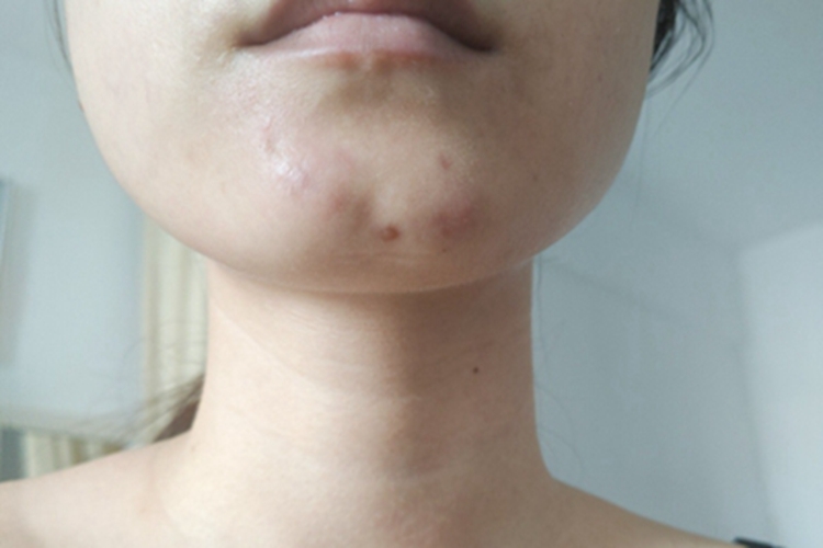 痤疮下巴皮肤颜色变深图 痤疮下巴皮肤颜色变深图