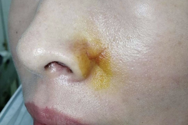 鼻翼皮瓣一年后的照片
