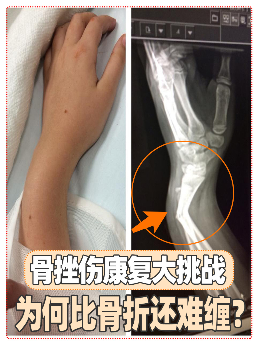 骨挫伤康复大挑战:为何比骨折还难缠?