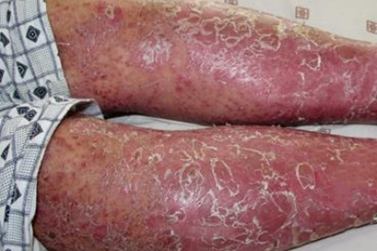 脓疱型银屑病红肿图