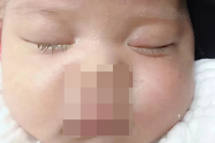 新生儿结膜炎眼睛有脓液图