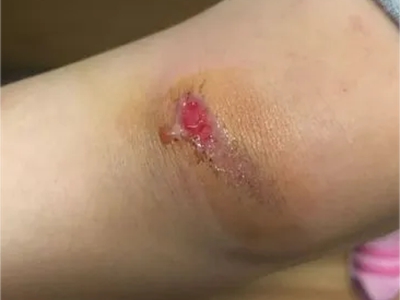 磨压伤膝盖有一个蚕豆大小的红斑图.jpeg