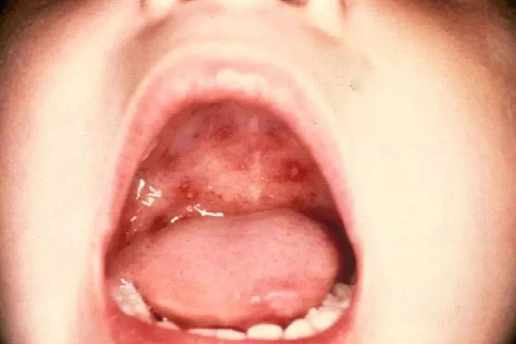 硬腭的小水疱图