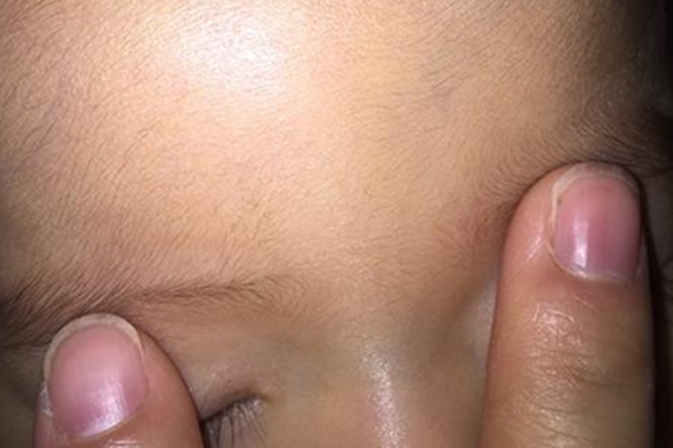 小孩鼻梁发青图