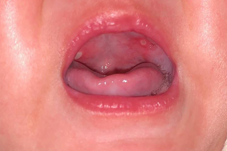 上颚小白点复发性口疮图 上颚小白点复发性口疮图