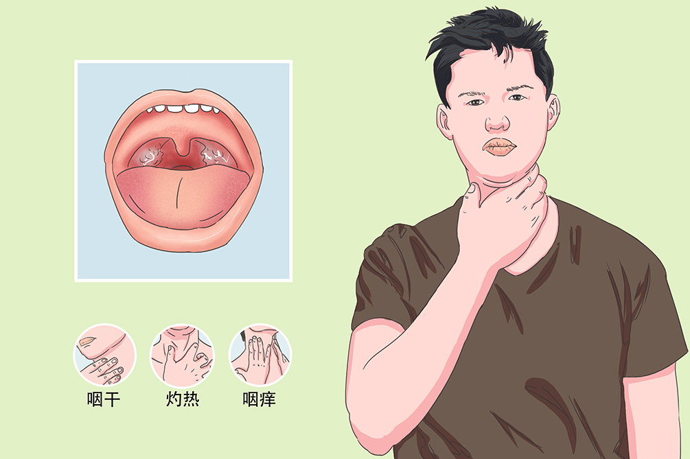 过敏性咽炎什么症状图片