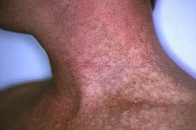 先天性角化不良脖子有花斑色沉图 先天性角化不良脖子有花斑色沉图