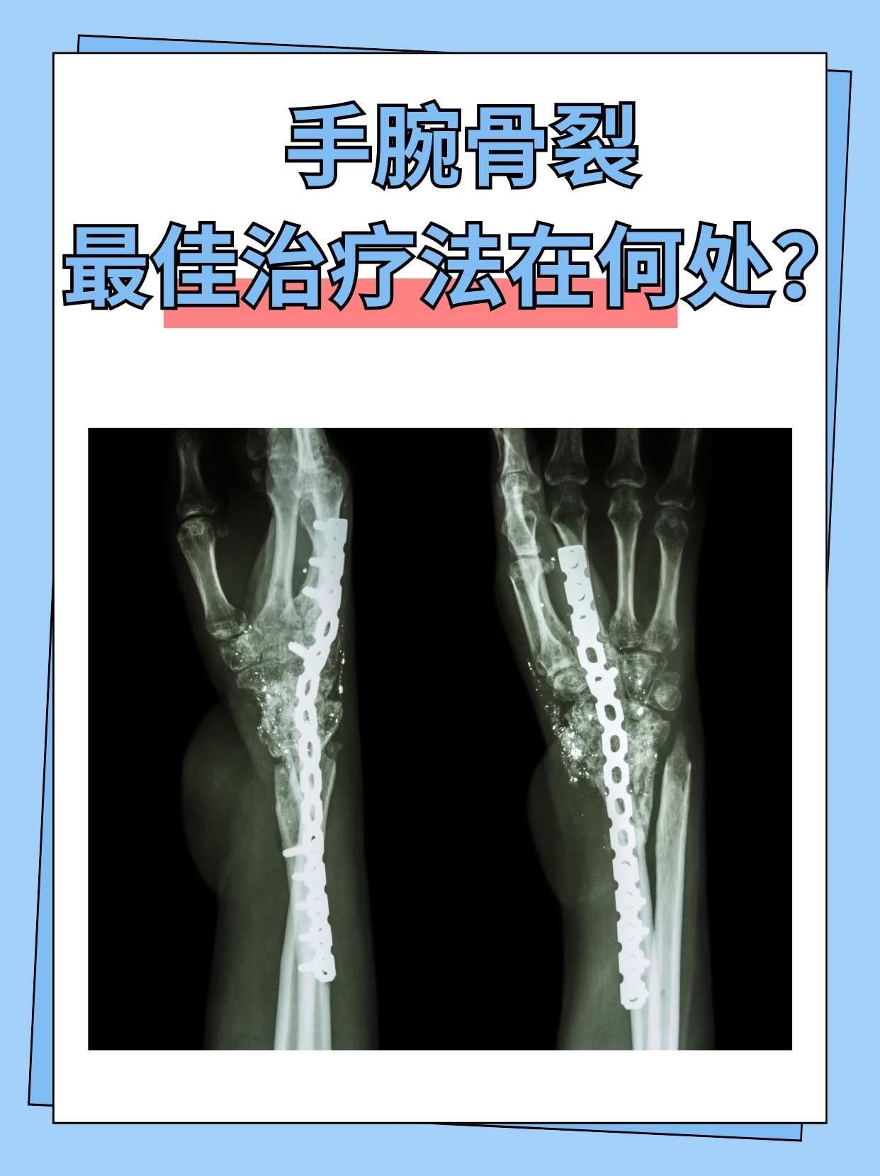 手腕骨裂,最佳治疗法在何处?