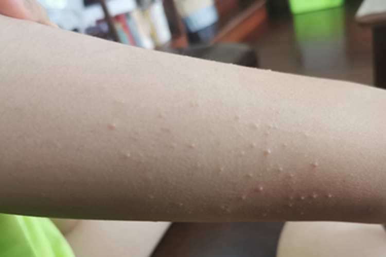 传染性软疣胳膊丘疹图