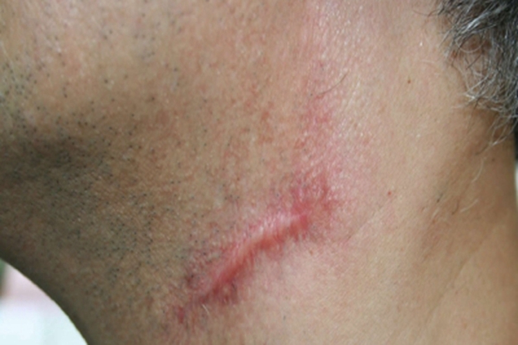 增生性瘢痕颈部症状图