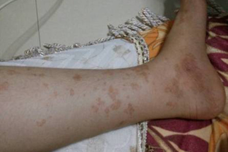 网状肢端色素沉着症状图 网状肢端色素沉着症状图