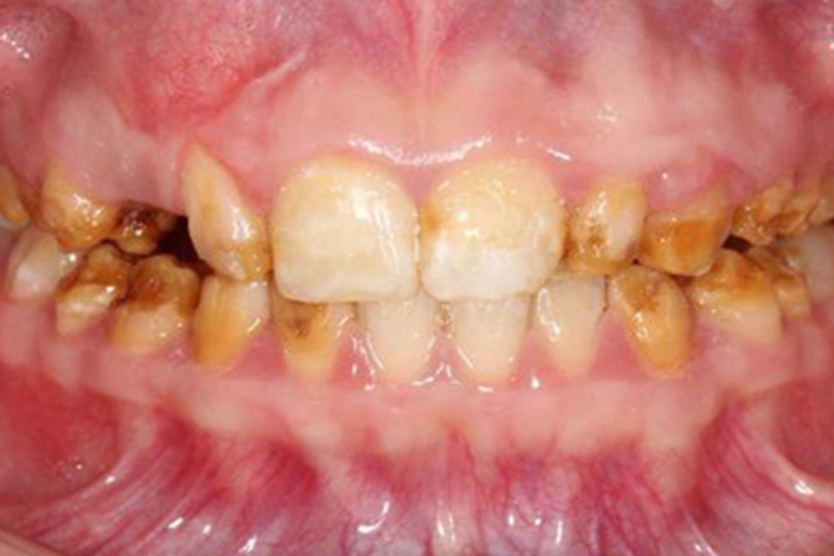 牙釉质发育不全出现大坑图