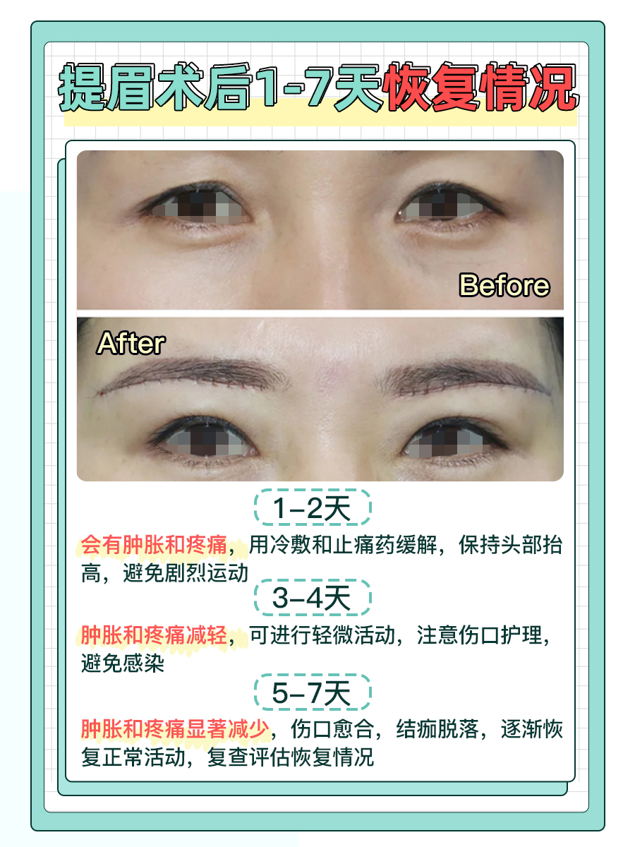 提眉术后1-7天恢复如何?专家解答