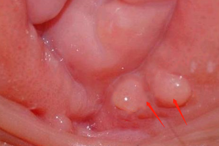 女性尿道口息肉图