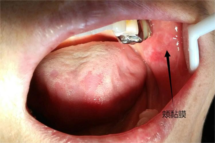 口腔颊部图片图片